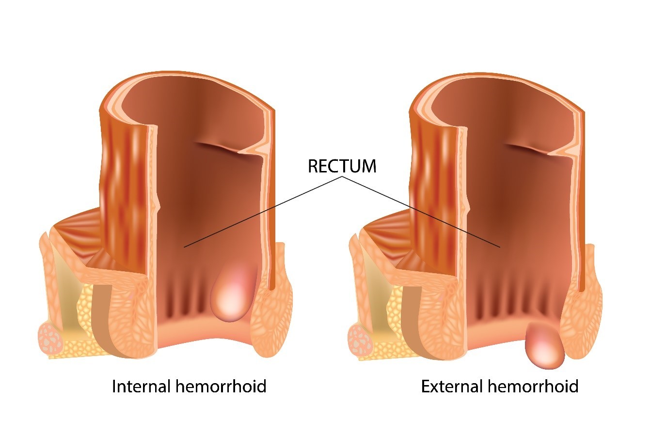 Haemorrhoids or piles