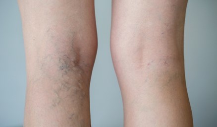 varicose veins