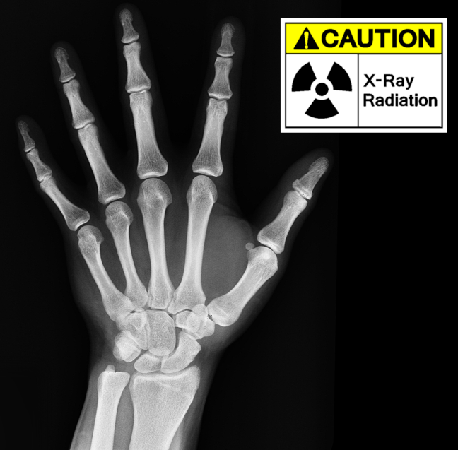 X-ray of hand