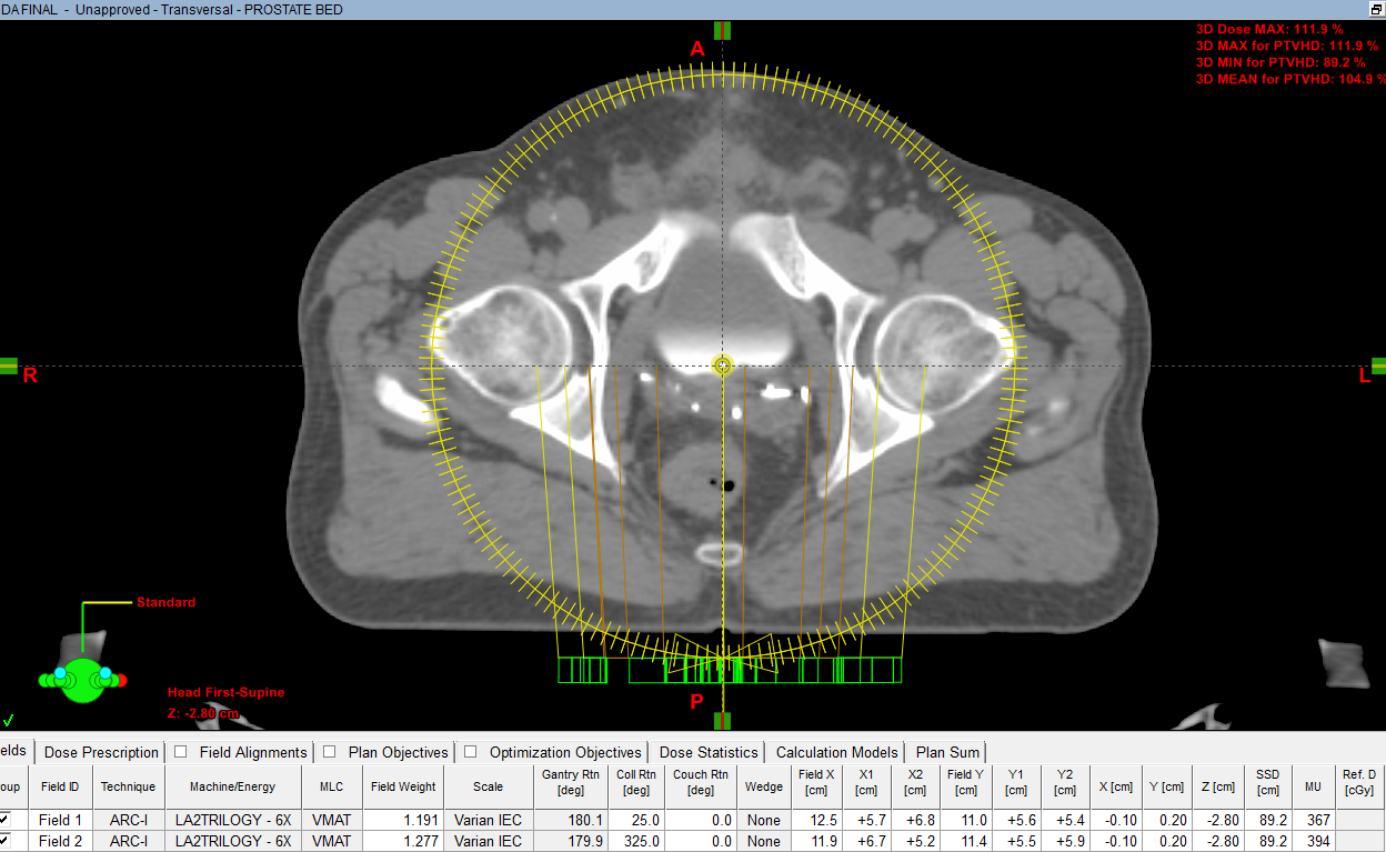 Volumetric modulated arc therapy Plan of a prostate