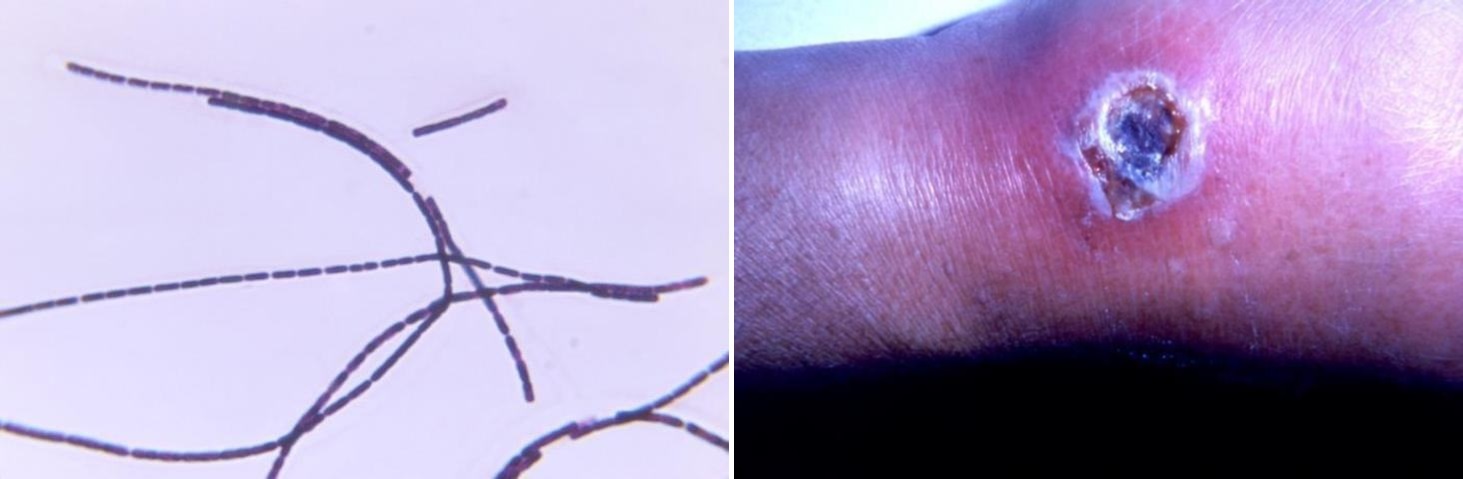 Left: Gram-stained photomicrograph depicts numerous Gram-positive, rod-shaped, Bacillus anthracis bacteria, which were arranged in long filamentous strands. Right: Photo of lesion located on the dorsum of a right hand