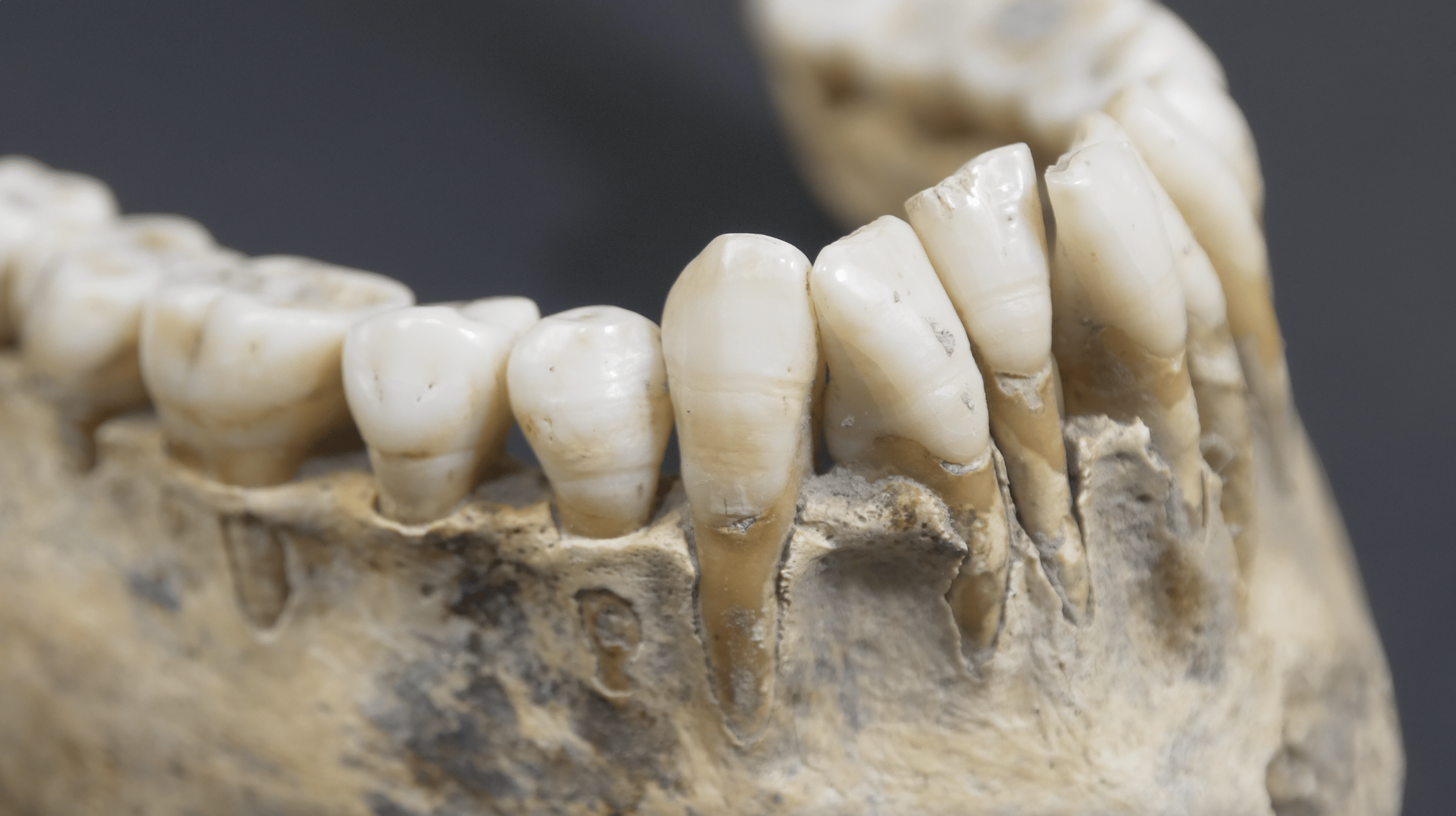 Teeth with signs of Hypoplasia