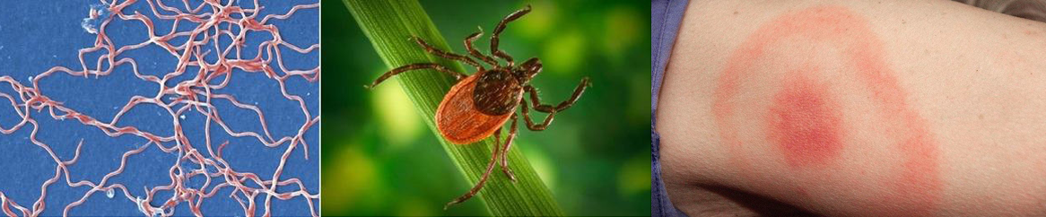 Left, digitally colorized scanning electron microscopic (SEM) image depicts a grouping of numerous, Gram-negative, anaerobic, Borrelia burgdorferi bacteria. Middle, Blacklegged tick. Right, Photograph depicts a red rash in the pattern of a “bull’s-eye”