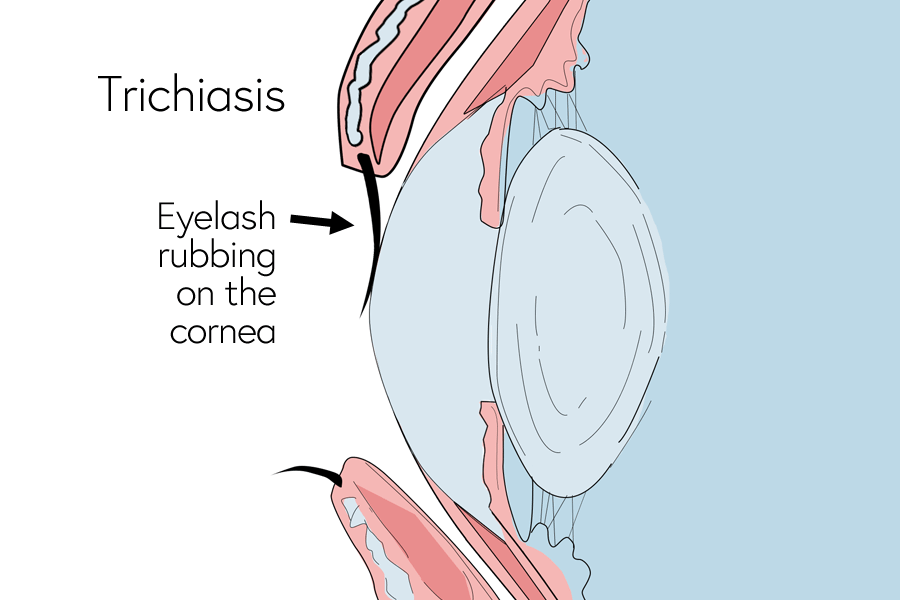 Image of trichiasis showing an eyeleash rubbing on the cornea