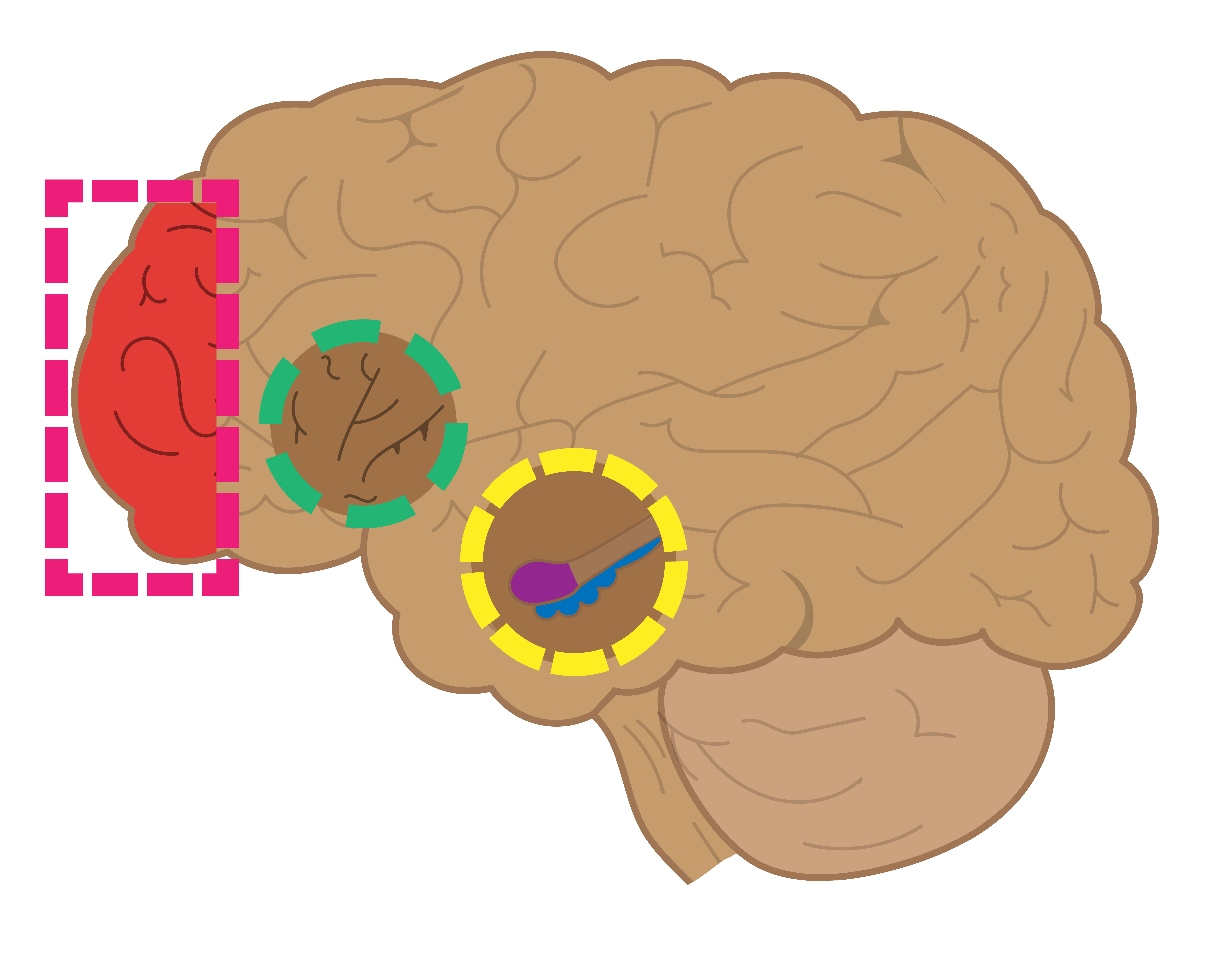 A cartoon image of a brain, with three circles highlighting four separate parts of the brain involved in PTSD: the insular cortex, the amygdala, the medial prefrontal cortex, and the hippocampus.