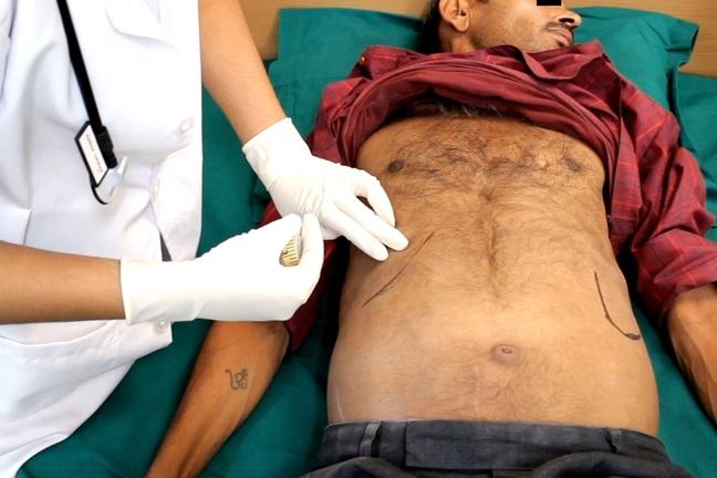 A doctor examines a suspected VL patient examined for hepatomegaly and splenomegaly