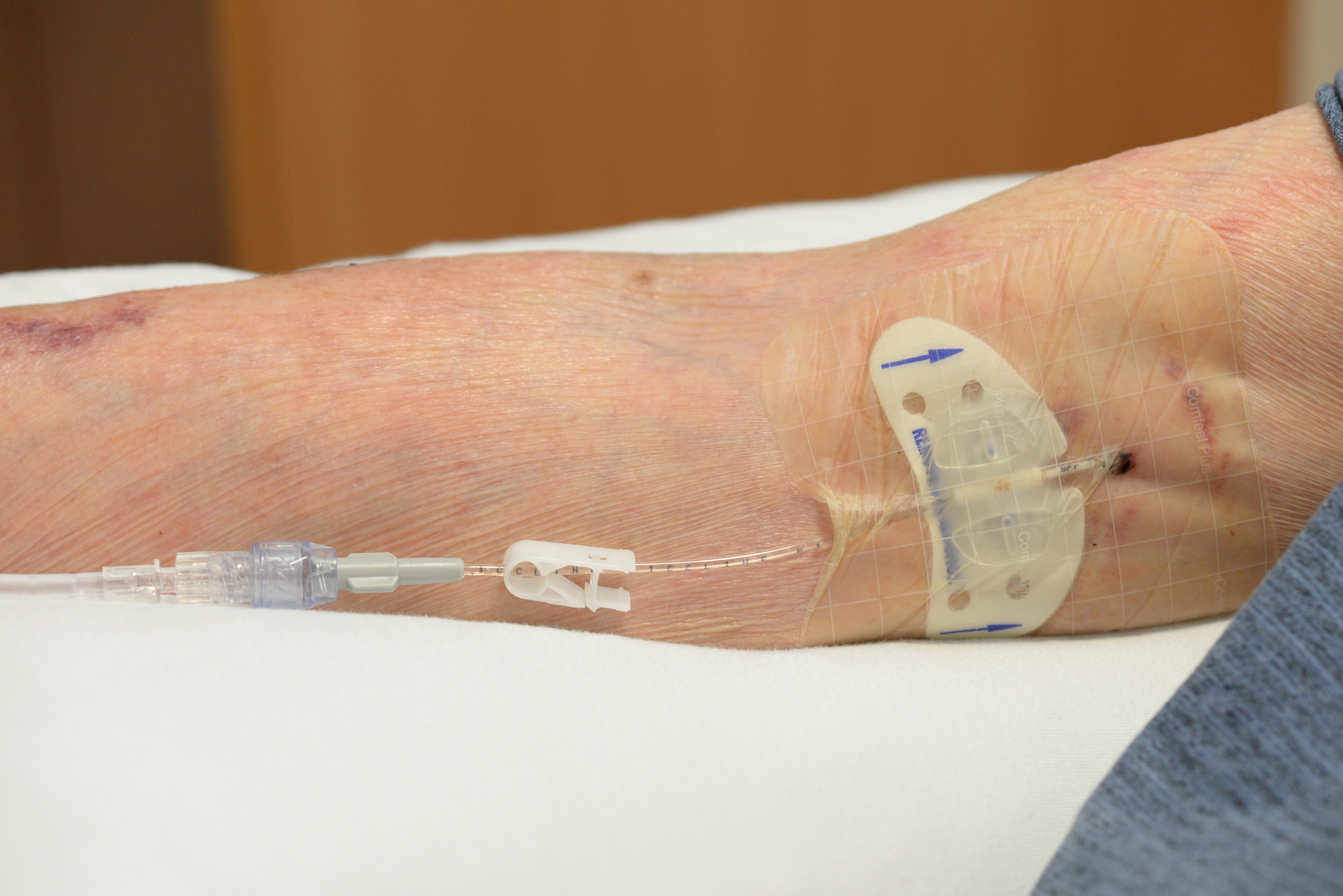 Patient arm with intravascular device in situ