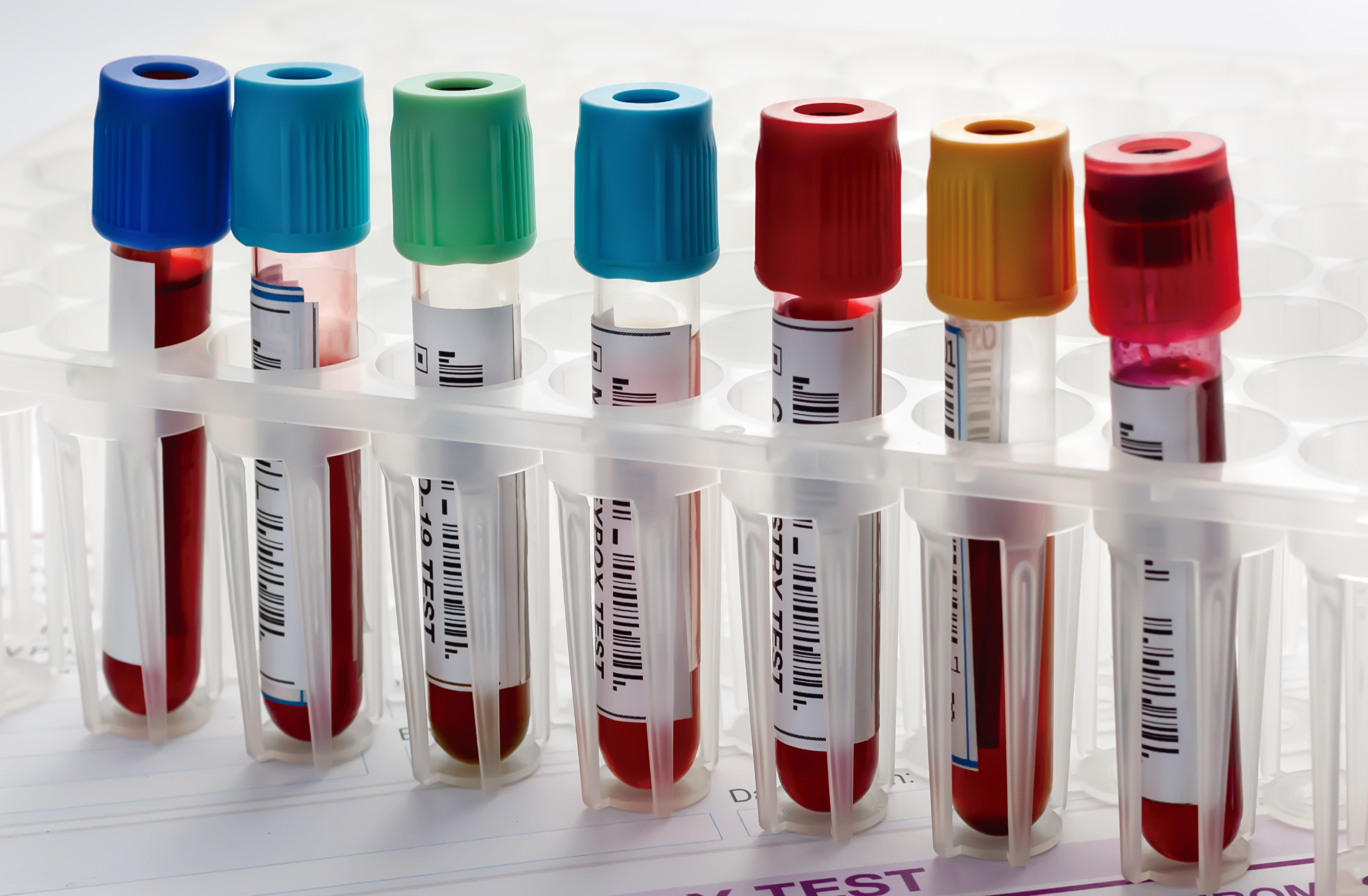 How do we diagnose fungal disease? A rack of tubes with blood samples in.