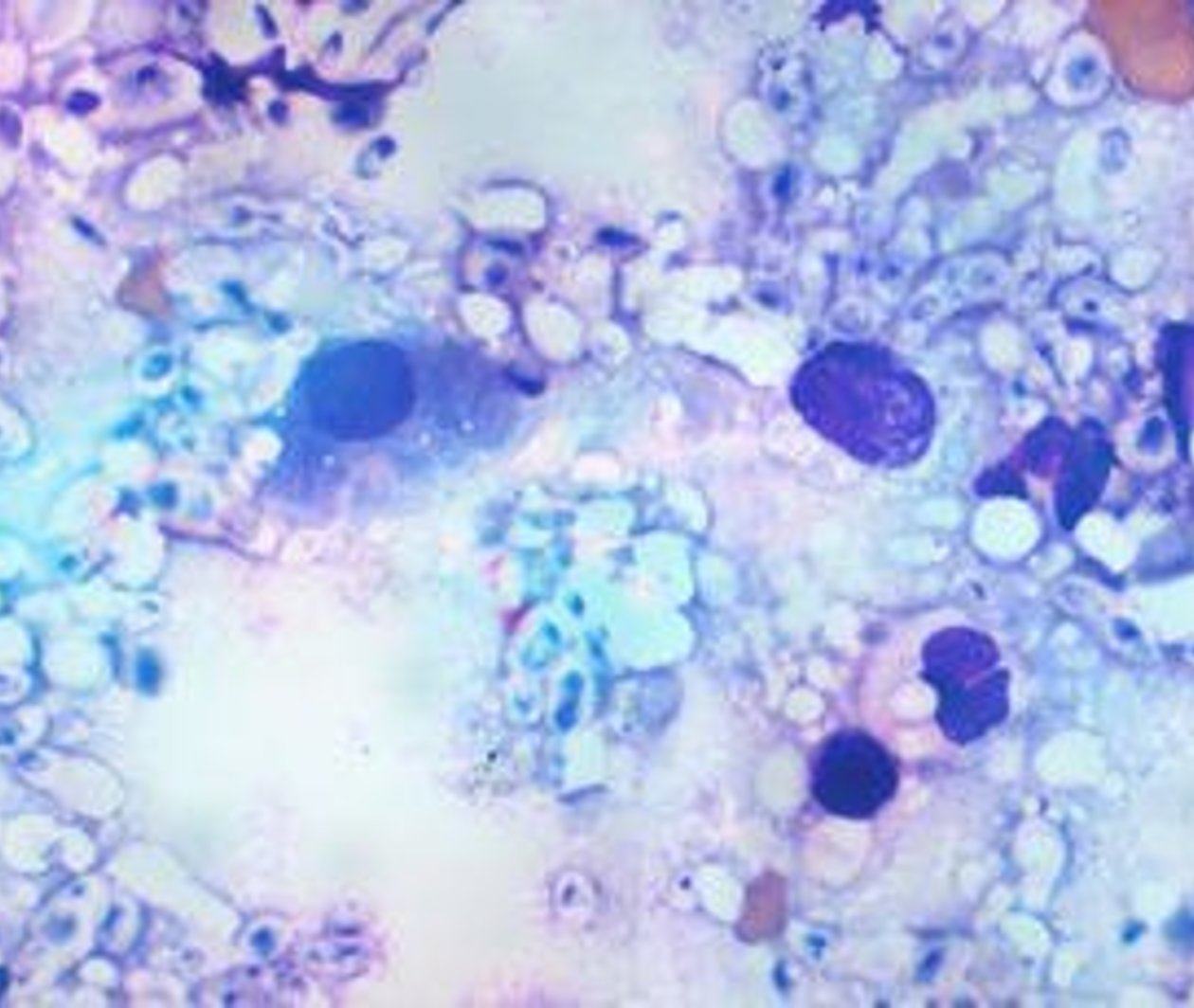 The Role of Antifungal Stewardship
