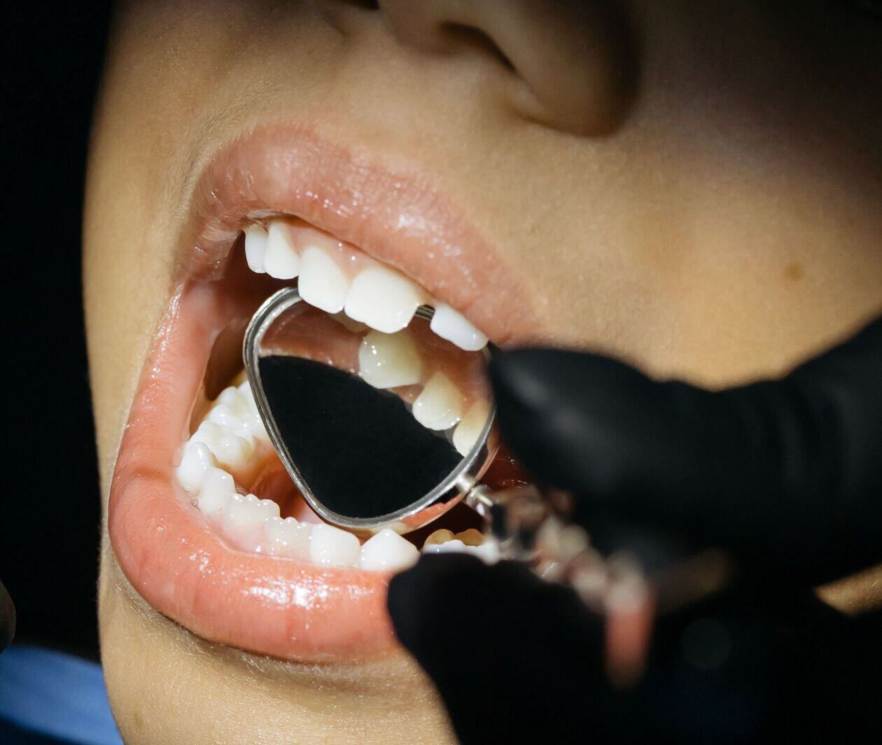 Clinical image of a dental mirror in a child's mouth