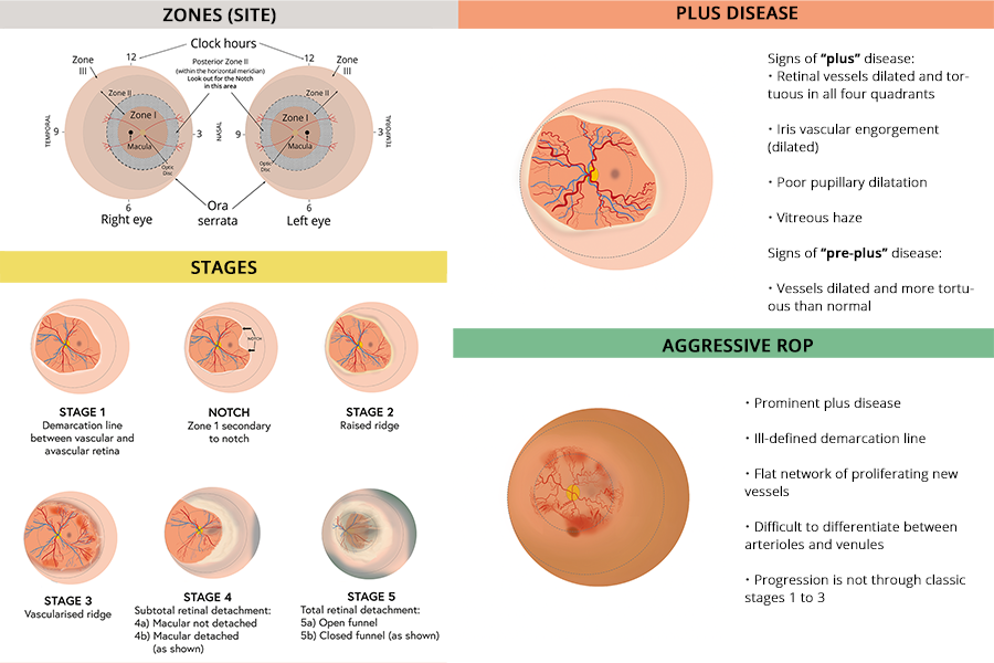 Excerpts from the job aid with illustrations for the zones, stages and types of ROP