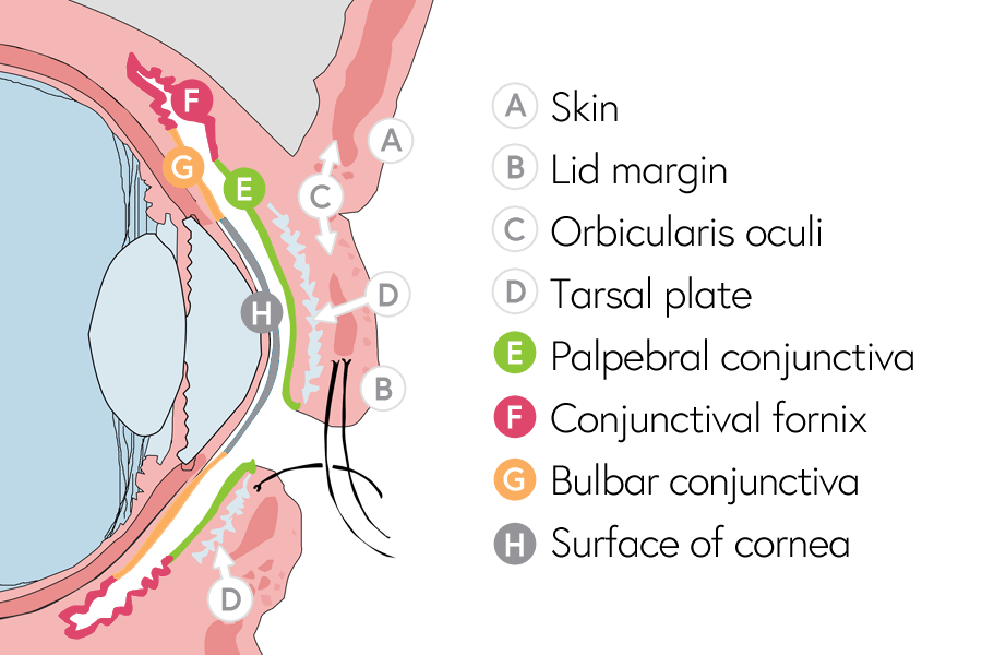 Anatomy of the eyelid showing where the lid margin, orbicularis oculi, tarsal plate and conjunctiva lie.