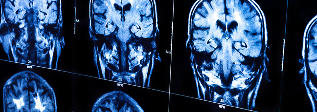 X-ray scans of human brains