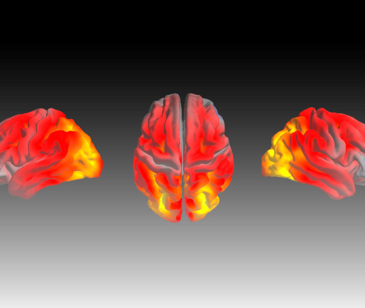 Image of a brain showing shrinkage due to a form of dementia