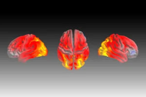 Image of a brain showing shrinkage due to a form of dementia