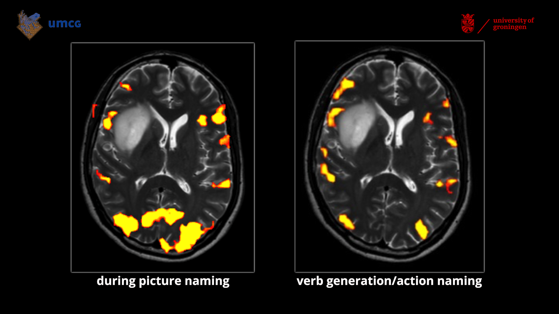 Activated brain areas during language tasks chart