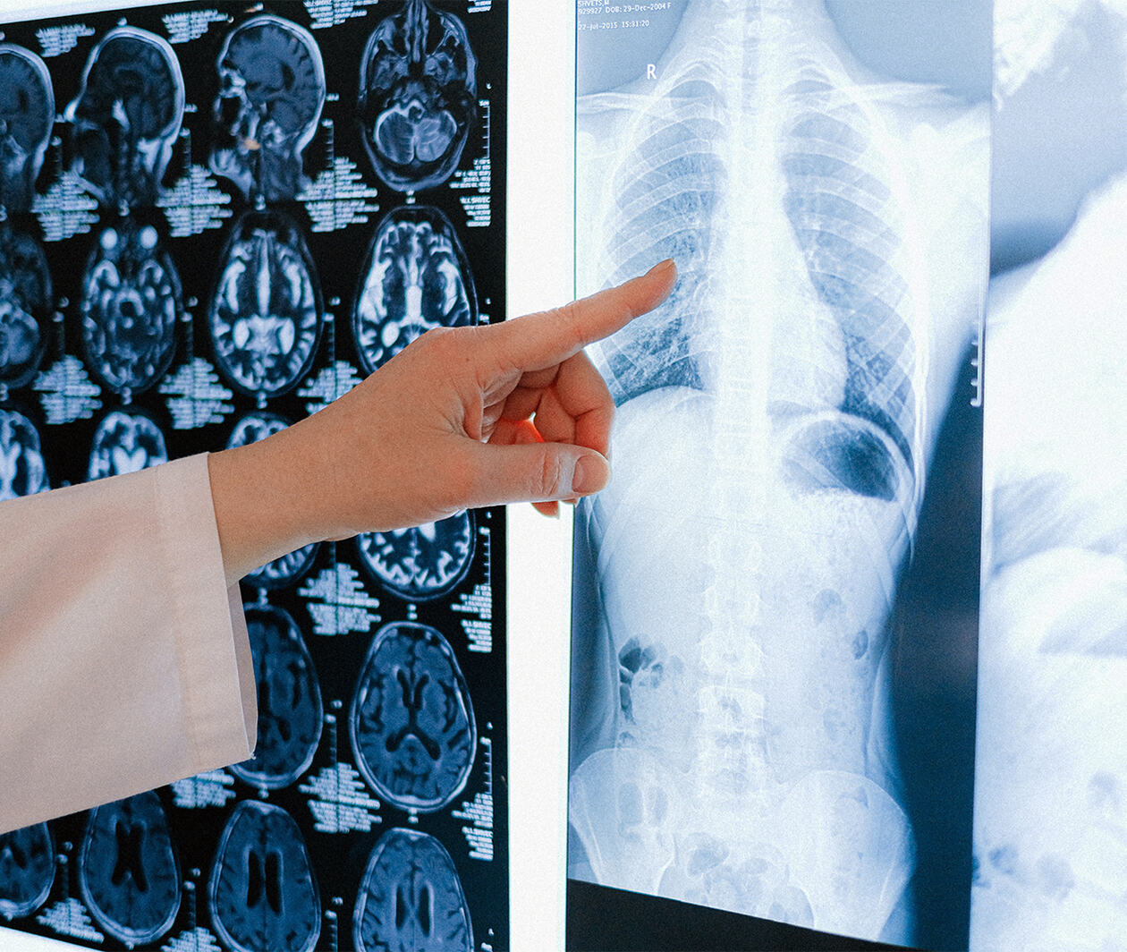 The doctor's finger pointed to the lung X-ray examination description