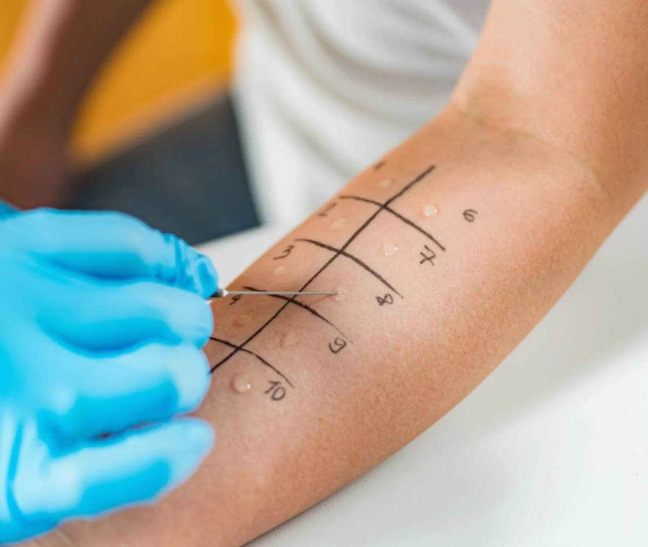 Doctor conducting an allergy test on patient's arm