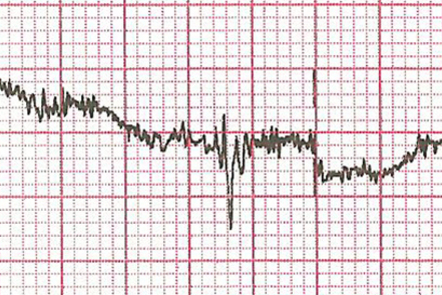 ECG