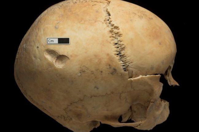 A skull with a peri-mortem depression fracture