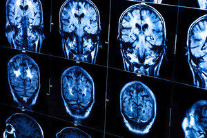 Human brain X-ray scan