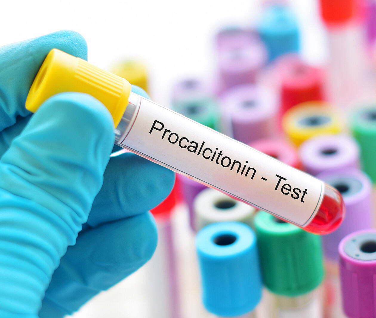 Sample tube with 'procalcitonin' label