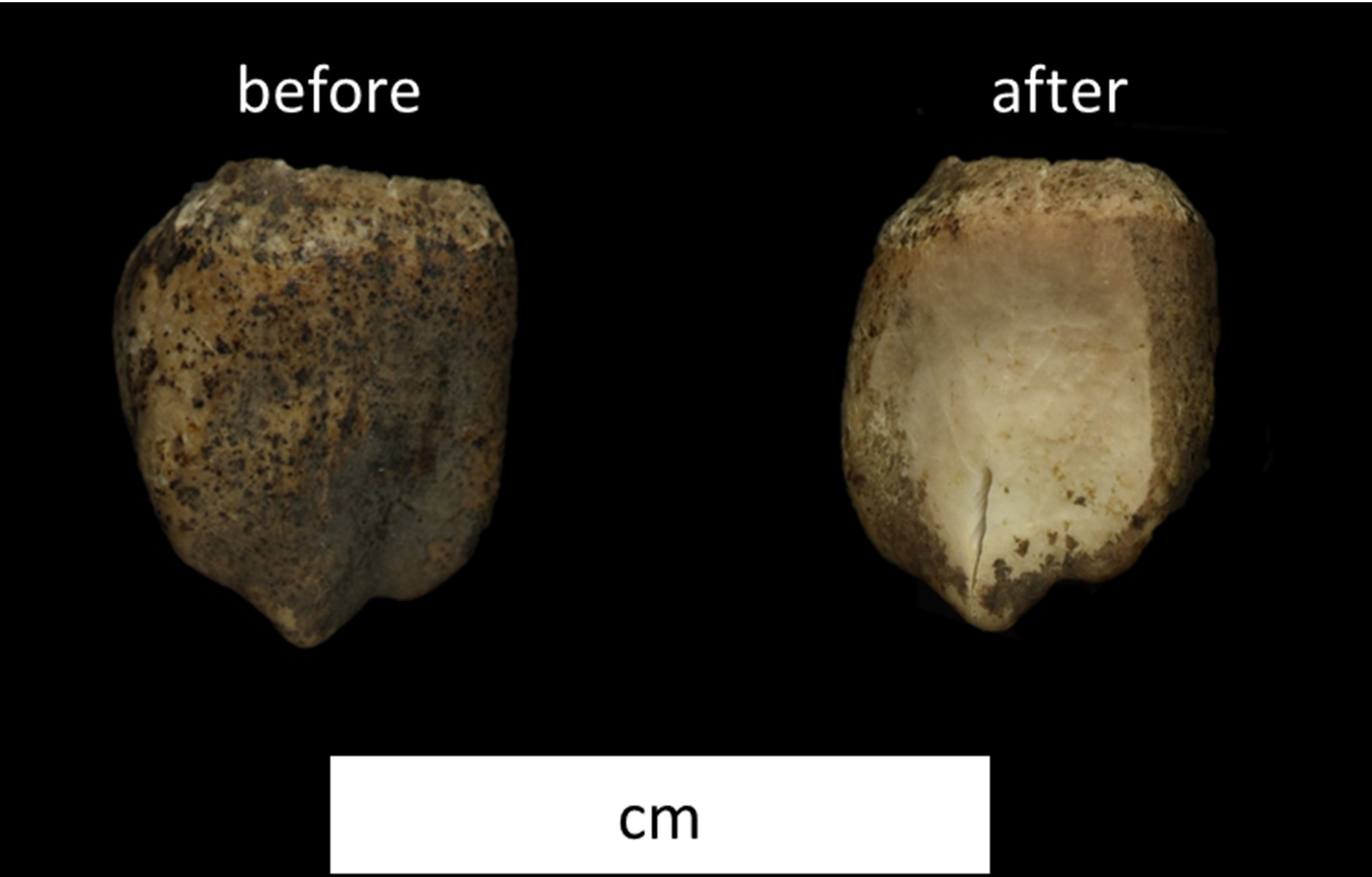 A tooth from a child shown twice. The left version shows the tooth before peptide preparation and the right version shows the tooth afterwards. There is a whiter patch on the right tooth due to the acid etch.