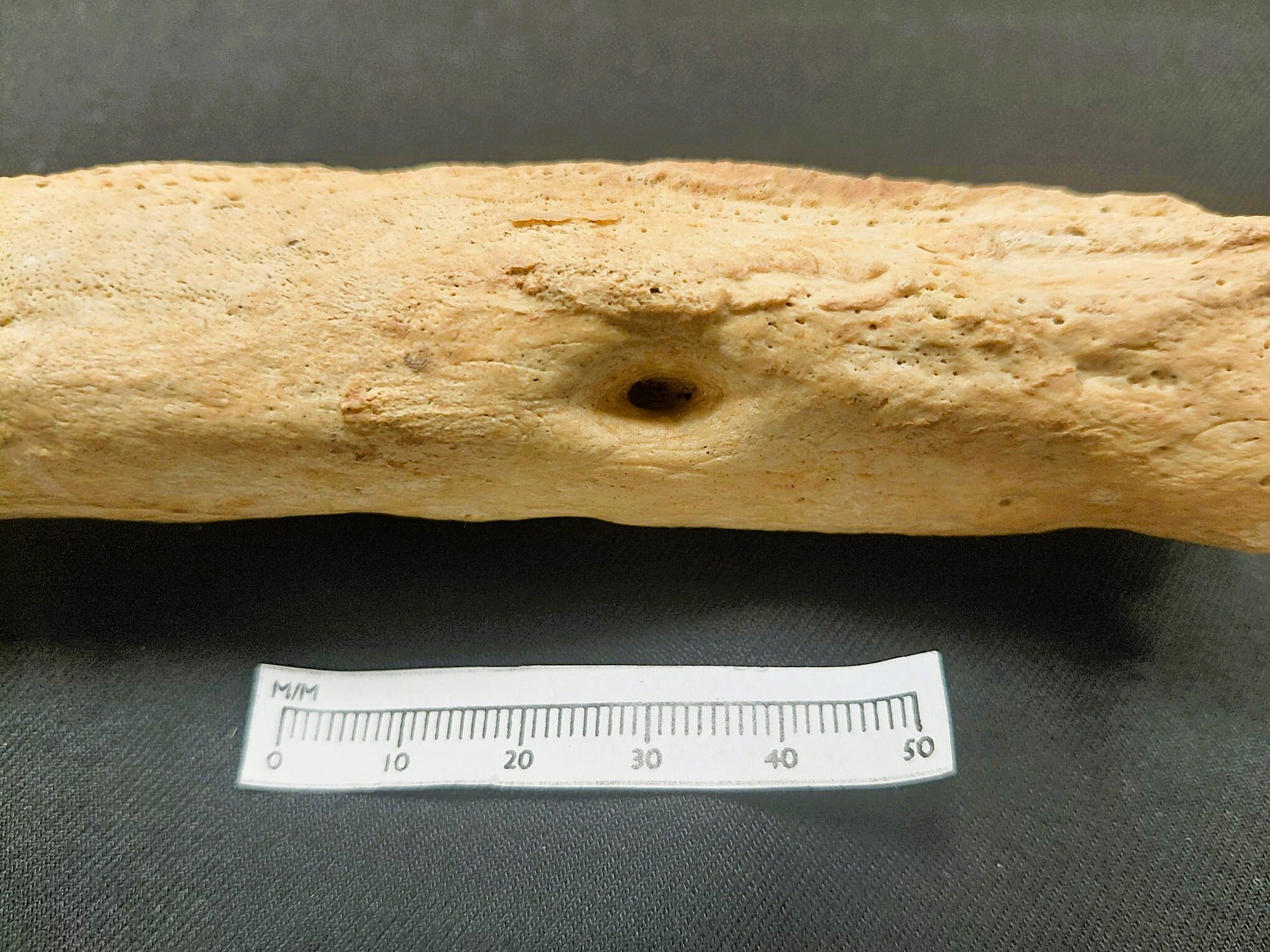 Osteomyelitis (infection of the bone marrow), with a hole (cloaca) from which the infection would have drained. A bone with osteomyelitis. The bone shaft is expanded and irregular with new bone formation on the surface. There is a hole in the bone which is a drainage channel through which infection could escape.