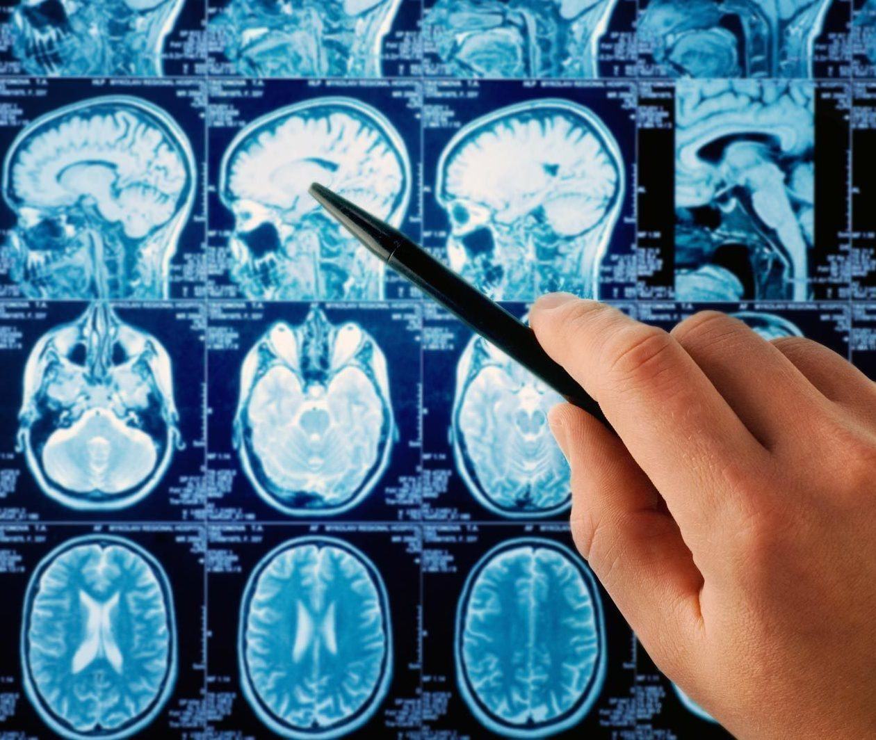 Scan of the human brain being used to diagnose Parkinson's disease