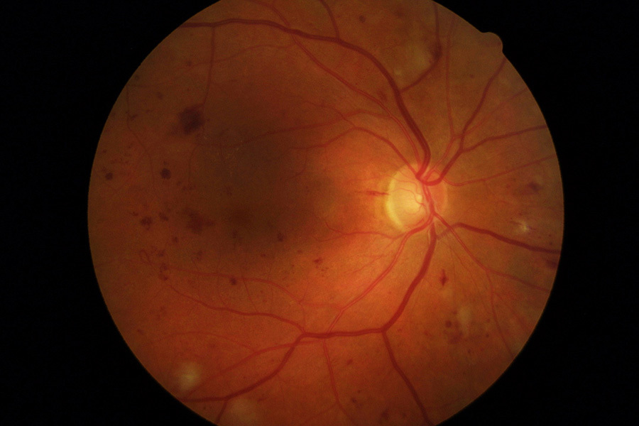 Fundus image showing the signs of severe non-proliferative diabetic retinopathy