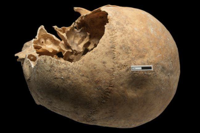 A skull with a depression fracture