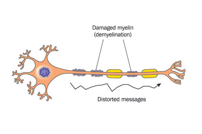 Diagram of demyelinated neurone.