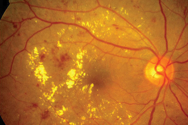 A fundus image of the retina of a person with diabetes