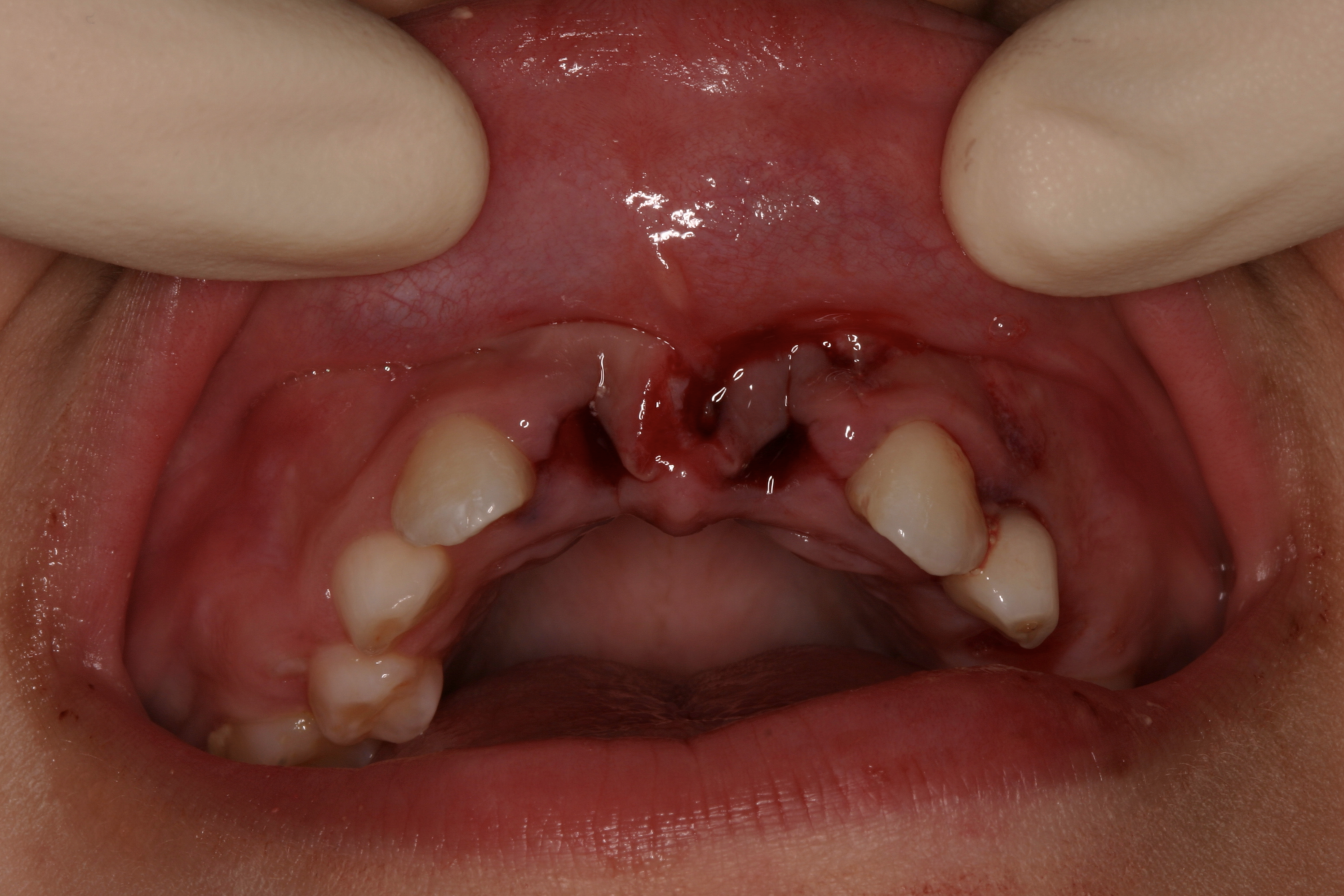 Picture of the upper arch of a young child in the mixed dentition. The upper permanent central incisors have been avulsed.