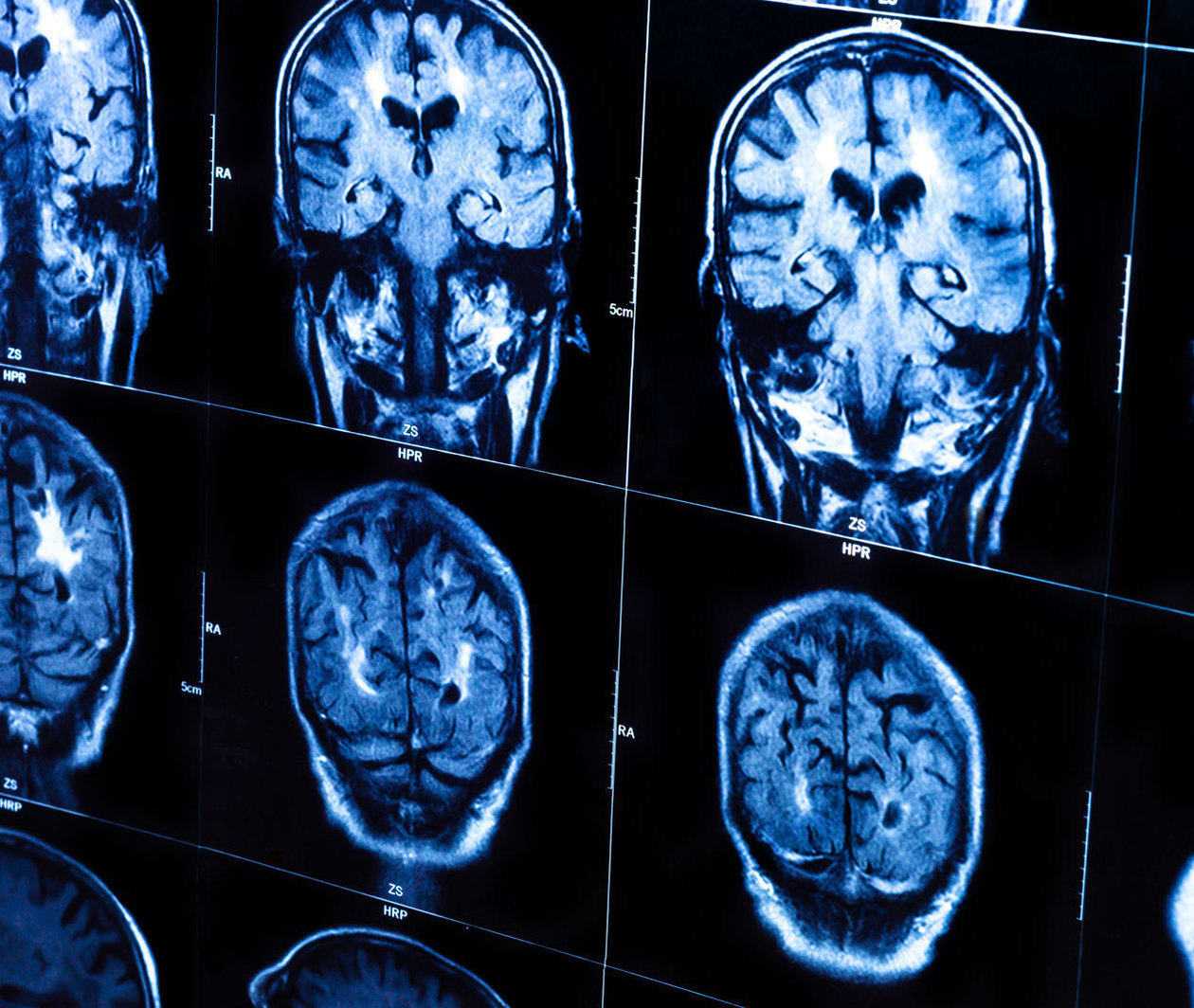 Good Brain, Bad Brain: Basics