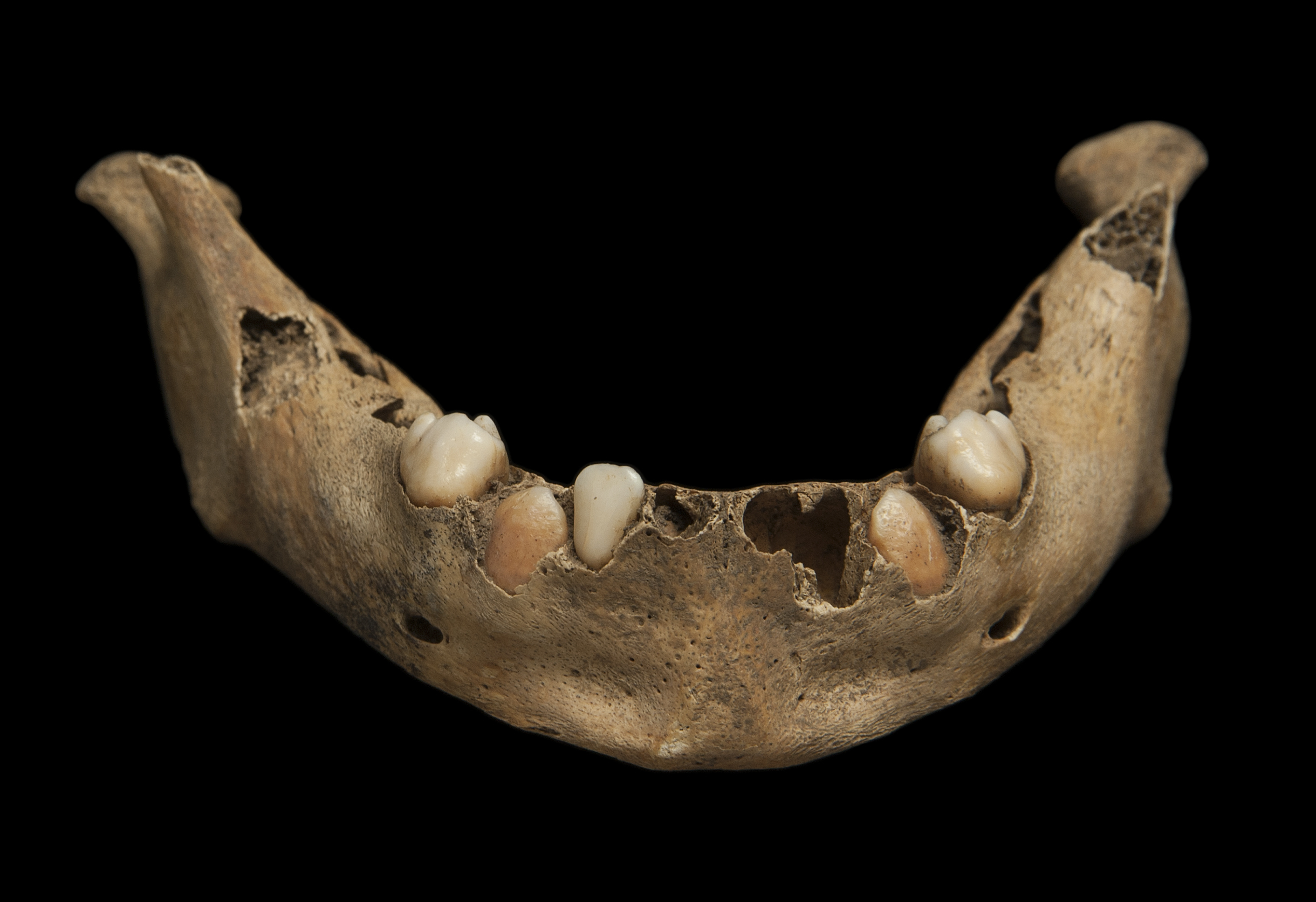 This image shows the mandible of a child, where the deciduous (primary/milk) teeth are erupting out of the jaw and into the mouth