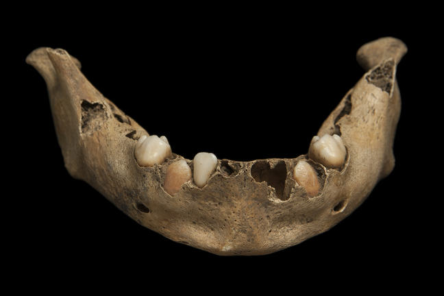 This image shows the mandible of a child, where the deciduous (primary/milk) teeth are erupting out of the jaw and into the mouth