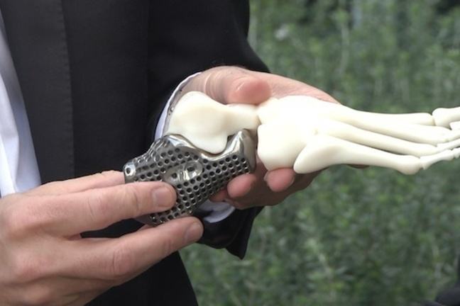 3D printed titanium heel