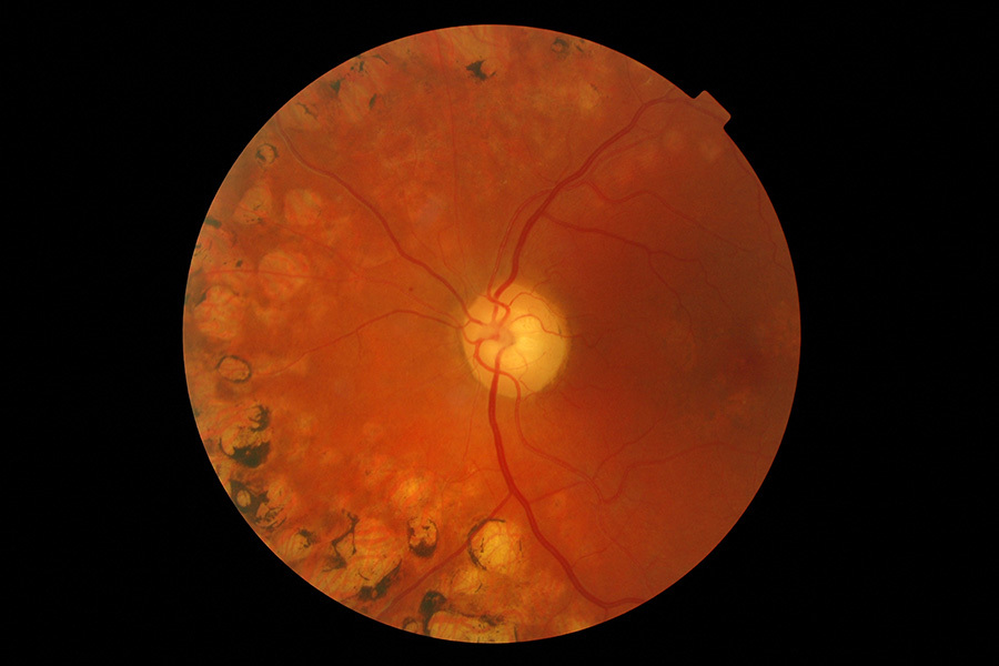 View of the retina showing burns from laser treatment for diabetic retinopathy