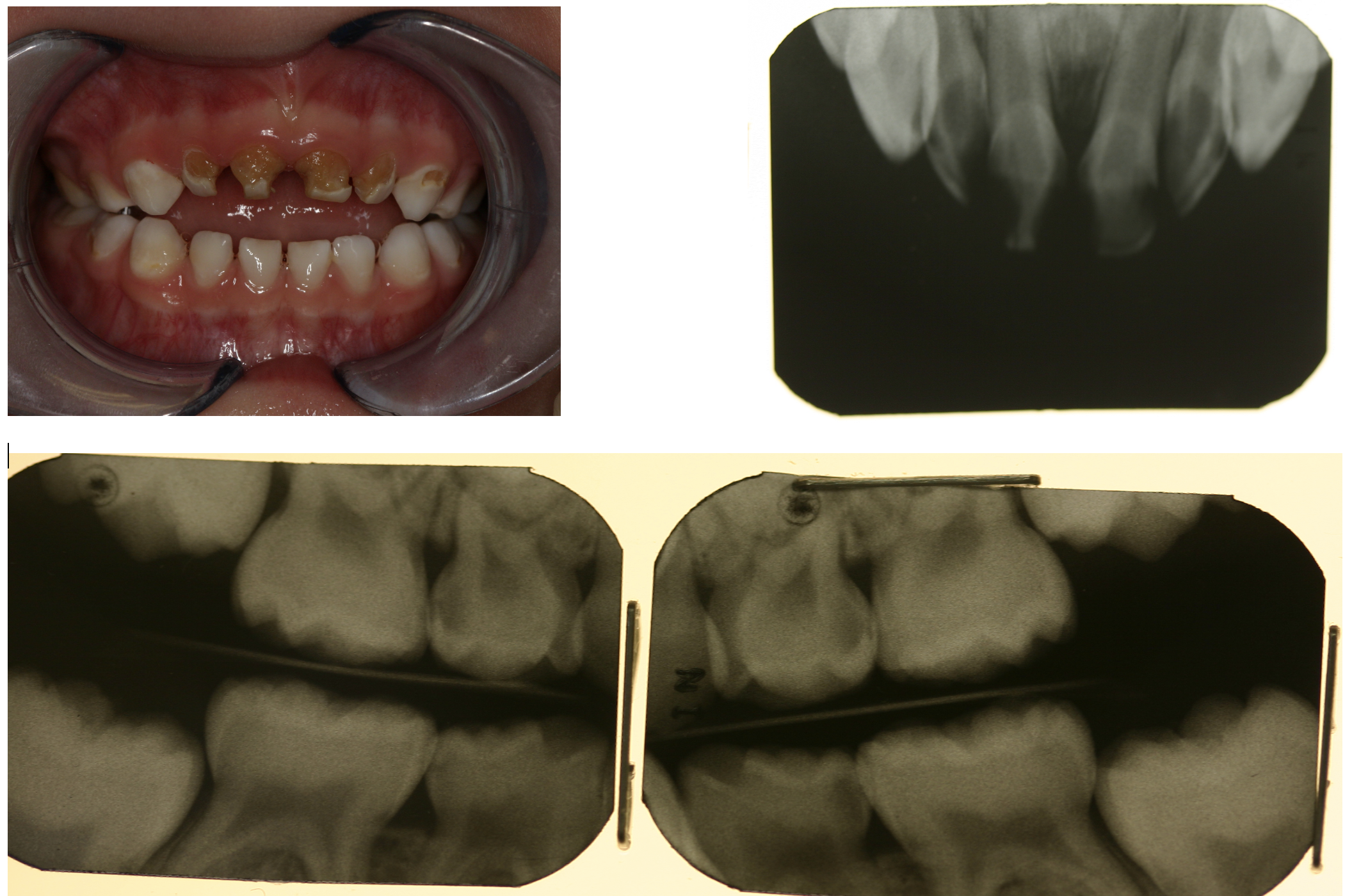 Photograph of primary teeth from the front, bitewings and anterior occlusal radiograph showing primary tooth caries