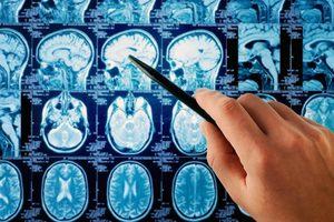 Scan of the human brain being used to diagnose Parkinson's disease
